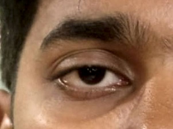 24 yr old Ashish needs help for his eye surgery