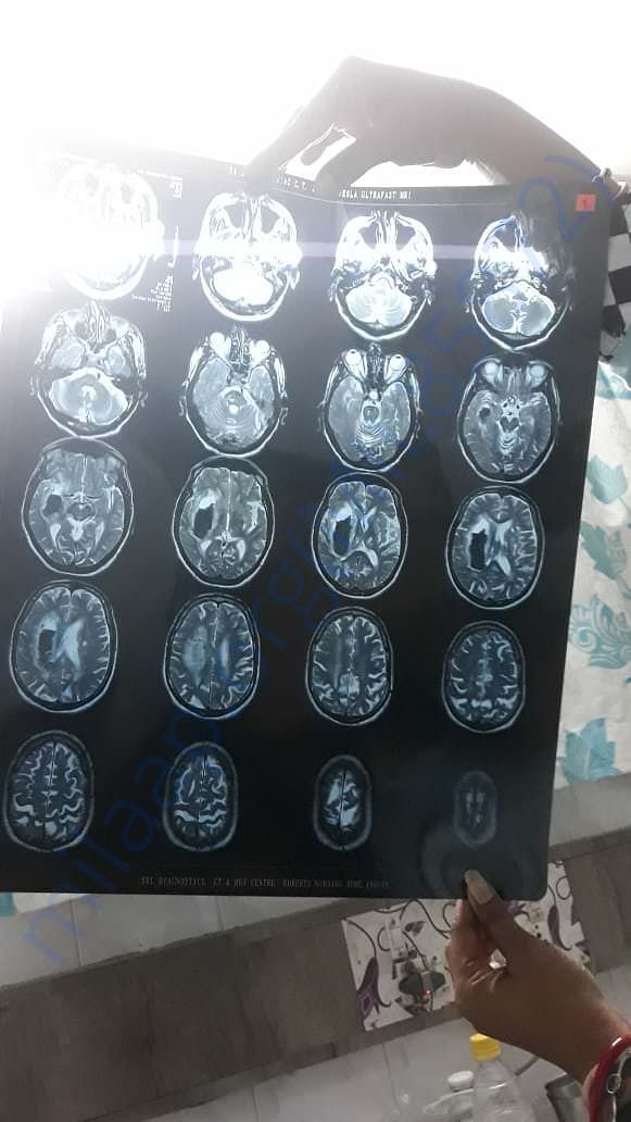MRI Scan