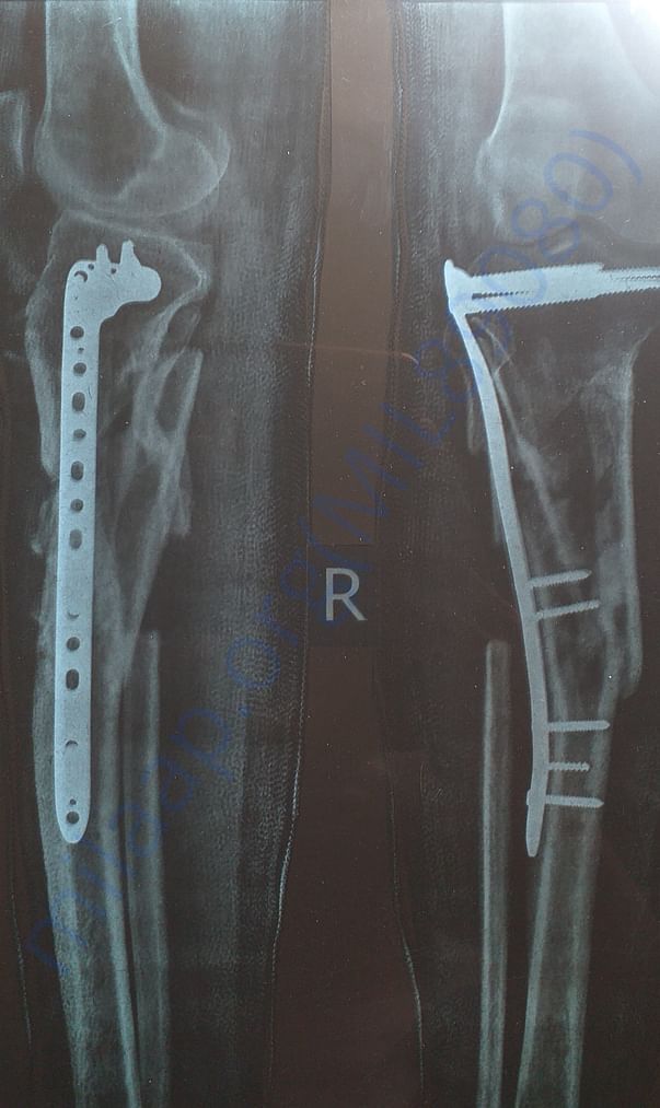 X ray