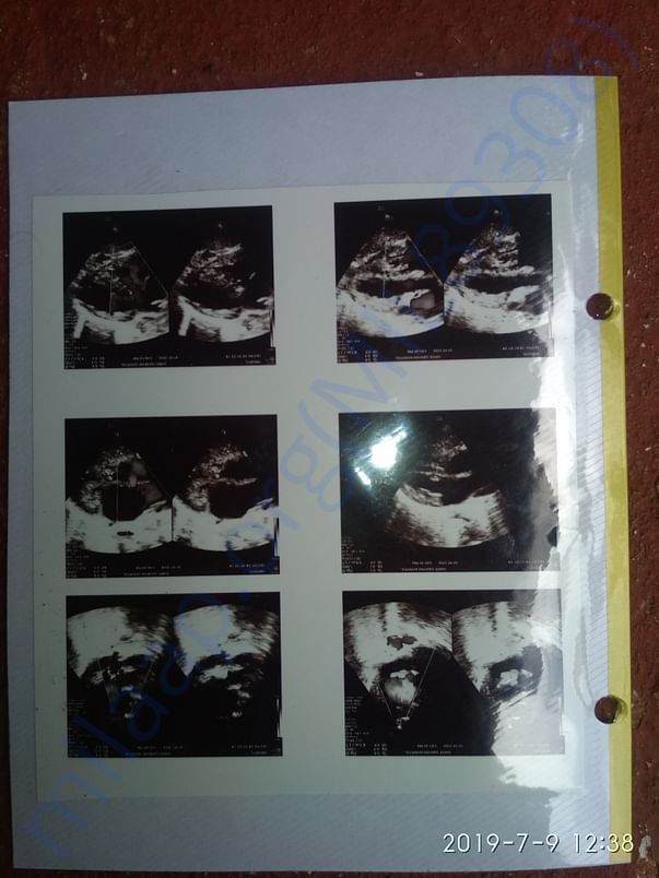 3. Echocardiogram_1