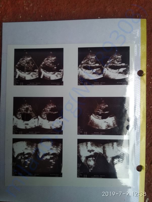4. Echocardiogram_2