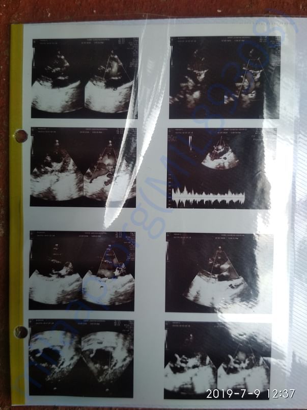 5. Echocardiogram_3