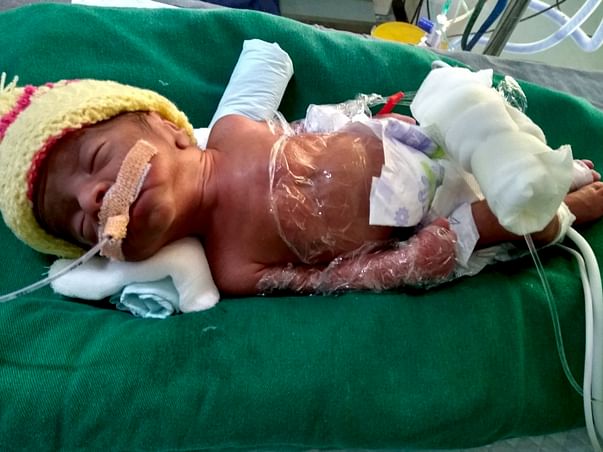 Help My Premature Baby Recover