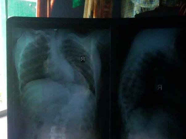 Help Tanuja fight scoliosis