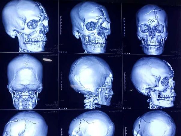 Help Kiran Recover From A Head Injury Due To an Accident!