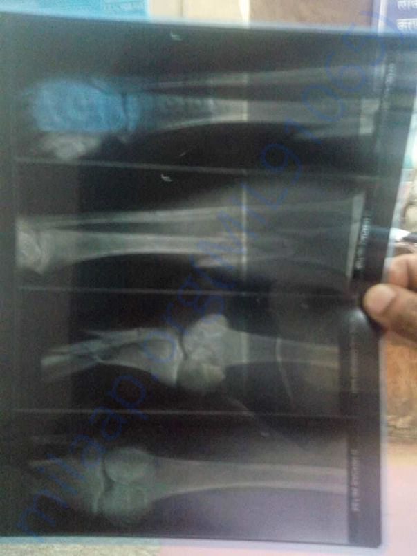This is the xray of his legs