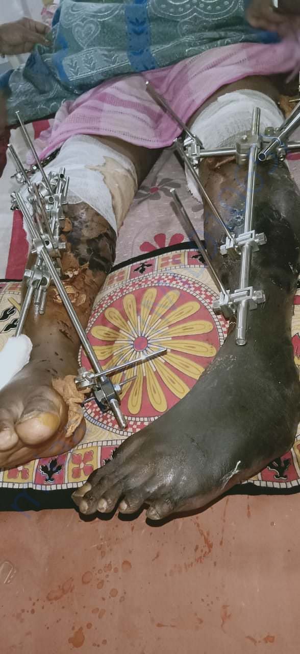 Both legs condition before cutting left leg