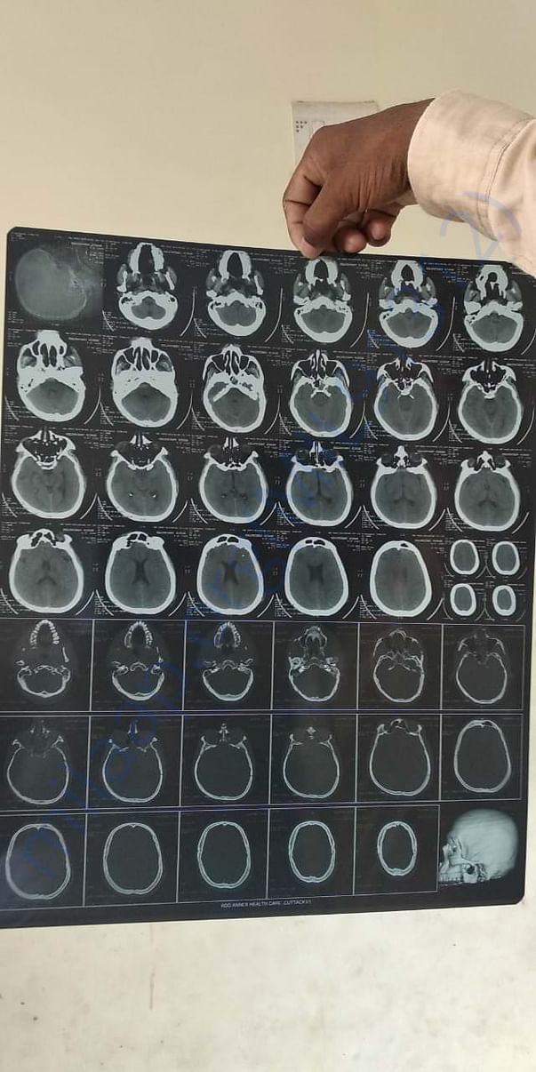 Brain xray