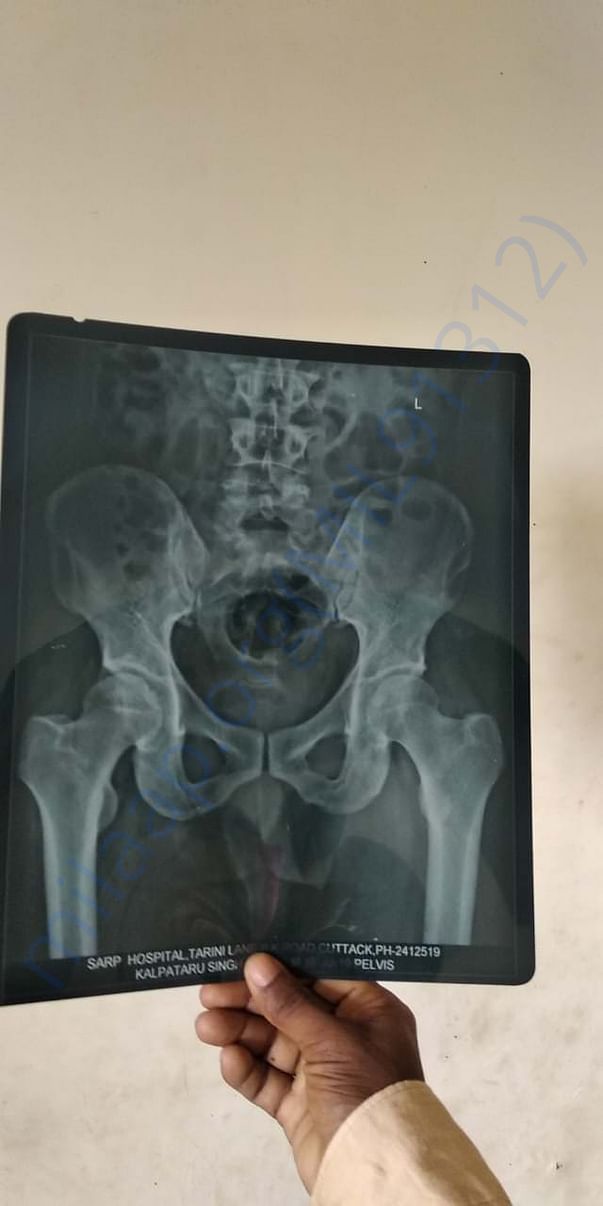 Shoulder bone broken xray