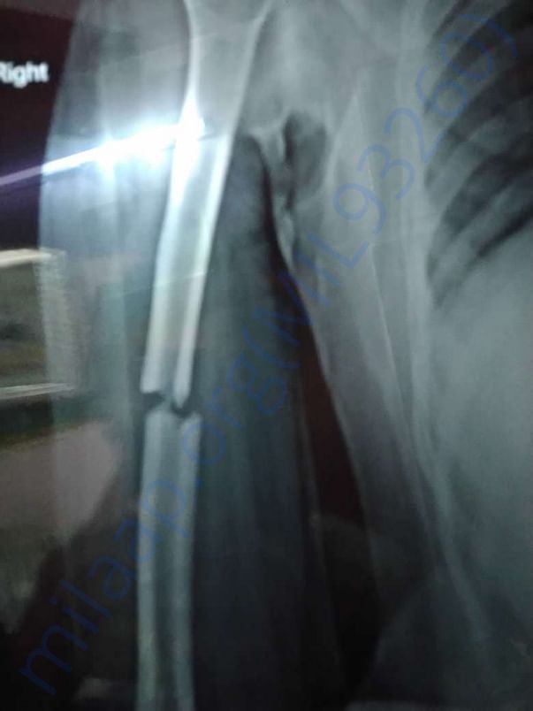 X-ray scan of the injured part