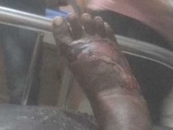 Help Myself Recover From Foot Infection And Surgery.