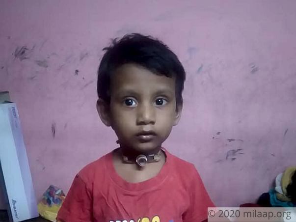 Help Yogesh Recover From Post Intubation Tracheal Stenosis