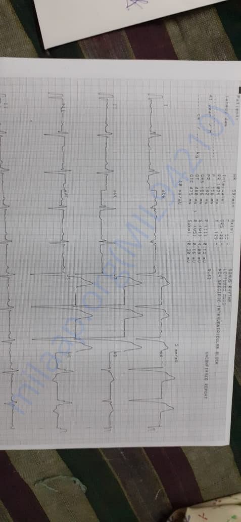 ECG
