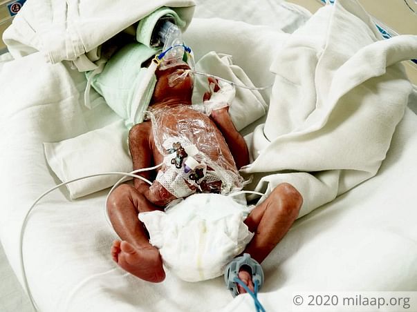 Twin babies of meenu needs your help to survive