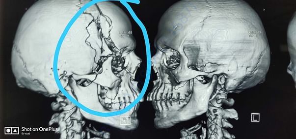 Scanning of his fractured skull