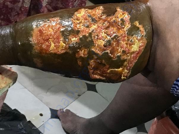 Wound Condition