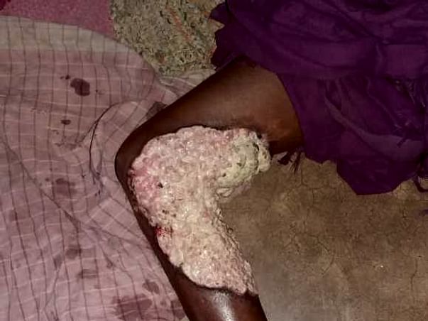 Help Shankar Fight Skin Cancer