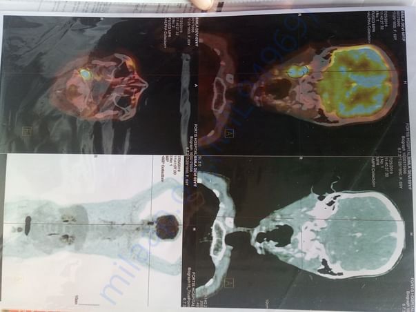 Pet scan picture