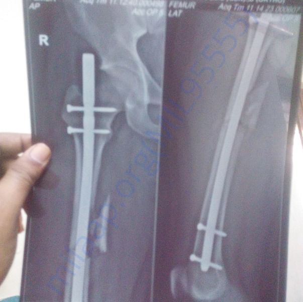 my femur Xray and look deeply one single is missing.