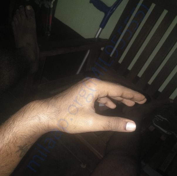 my wrist condition now.