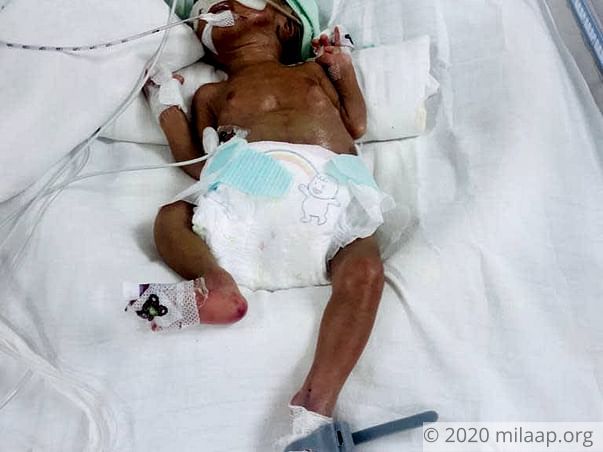 baby of manju devi neonatal sepsis