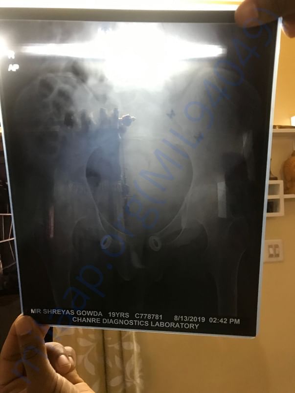 X-Ray of hips being fusion