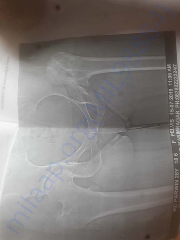 Bone narrow surgery