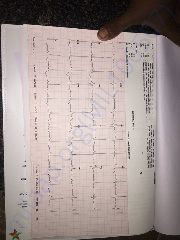 ECG