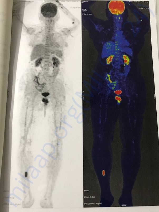 WHOLE BODY PET SCAN (page4of6)