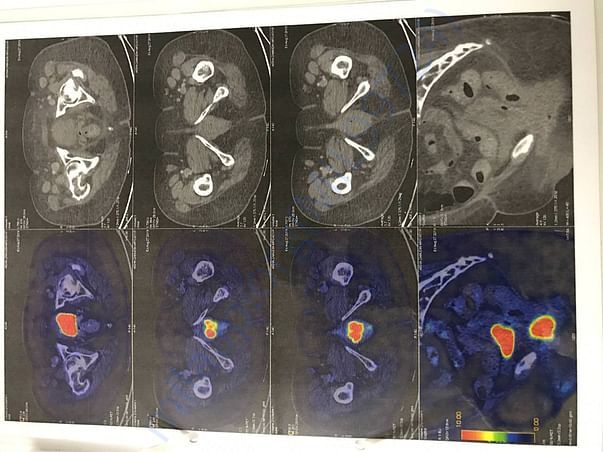 WHOLE BODY PET SCAN (page5of6)