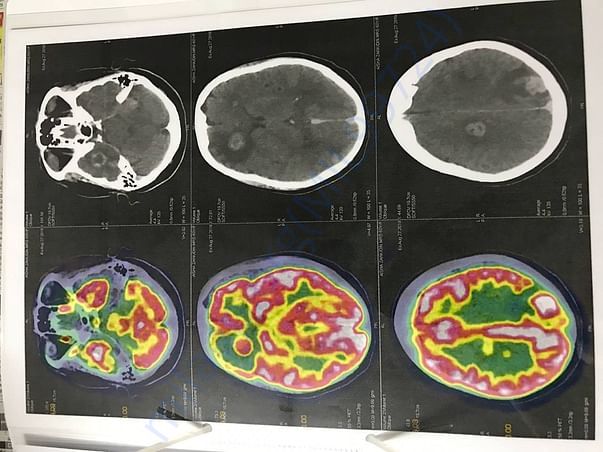 WHOLE BODY PET SCAN (page6of6)