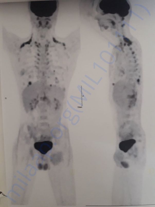 PET SCAN