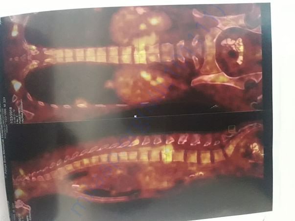 PET SCAN 1
