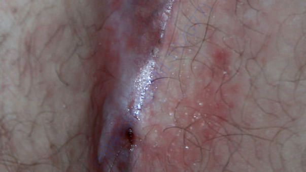 Swelling day by day