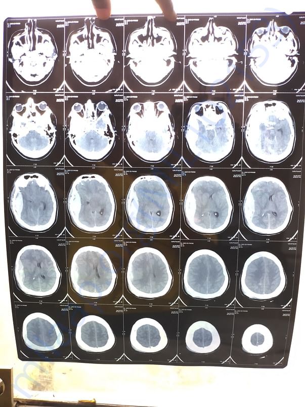 Ct scan