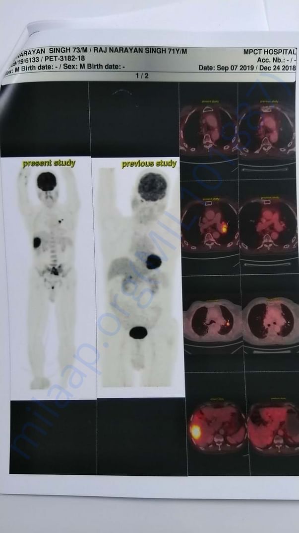 Pet-CT