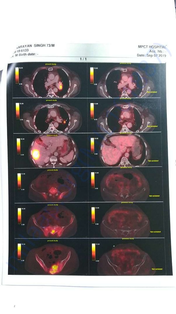 Pet-CT