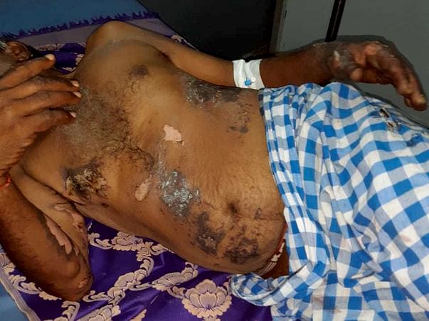 Help Rajanna Recover From Electrocution