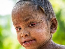 This 6 Years Old Needs Your Urgent Support In Fighting Skin Condition