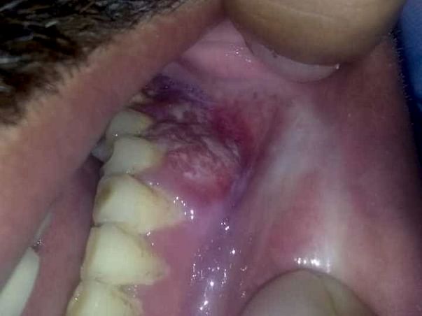 38 Years Old Gaurav Tiwari Needs Your Help Fight Oral Cancer