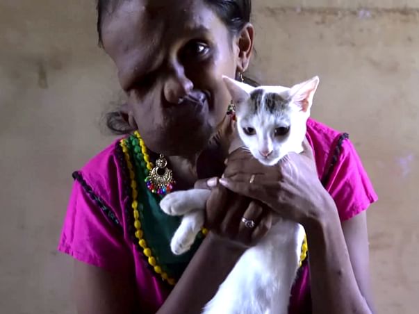 A Rare Disease Has Melted This 24-Yr-Old Chennai Woman’s Face