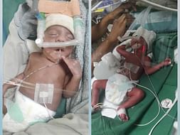 Help my twin daughters battling for life in NICU.