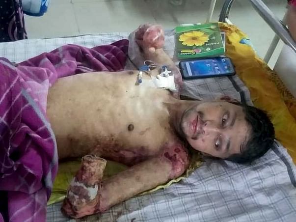 Help My Friend Zameer Recover From Fire Accident