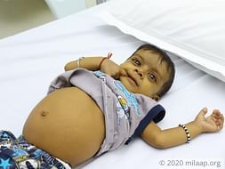 Help Little Mayank Fight Biliary Cirrhosis