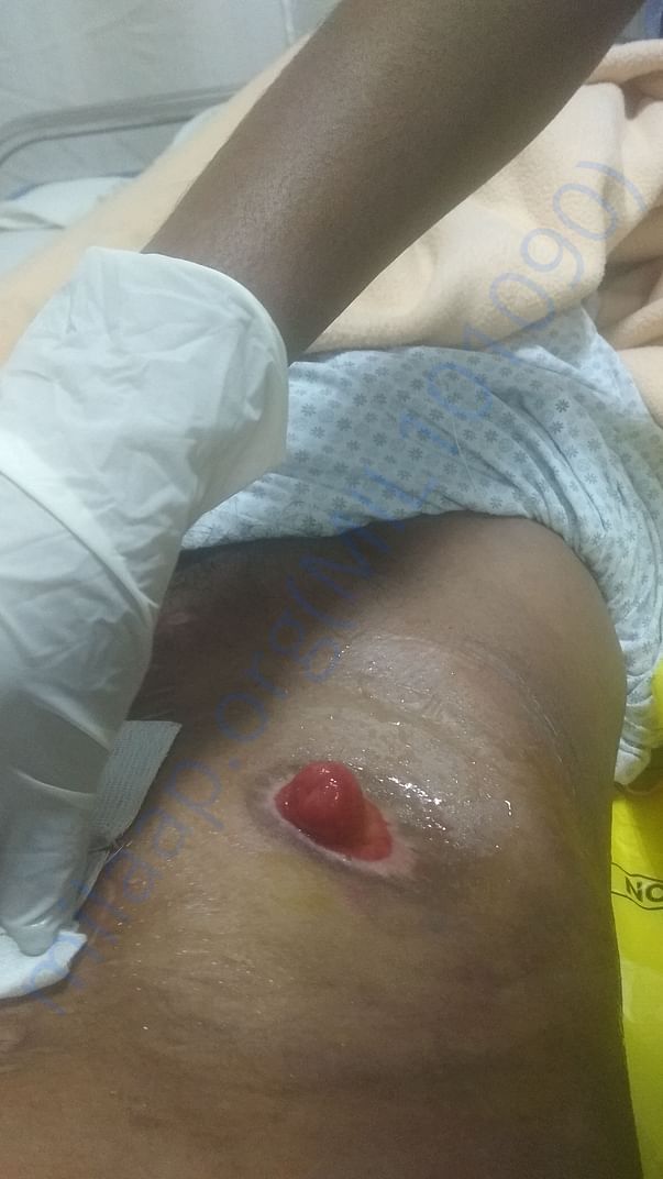 Stoma