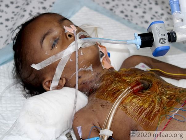 Help Naresh Recover From Congenital Heart Disease