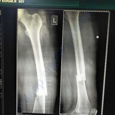 Legs are broken