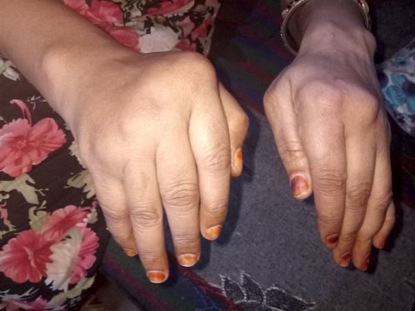 Help Me To Cure My Mother's Arthritis