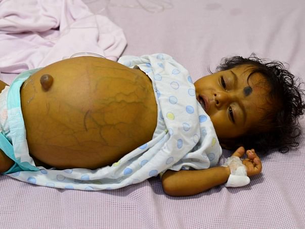 My 9 month old son needs a Liver Transplant as soon as possible