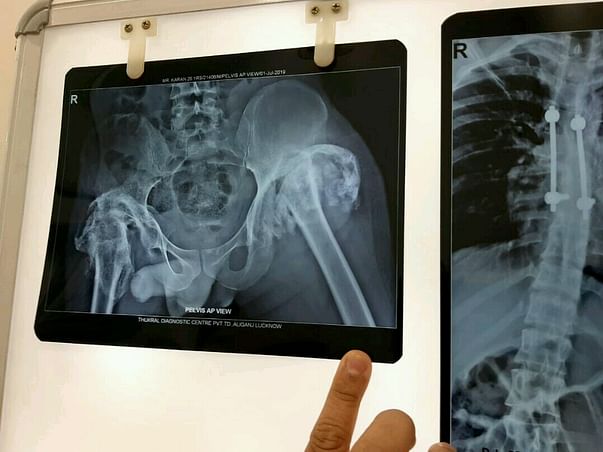 Help Karan Undergo Knee Surgery